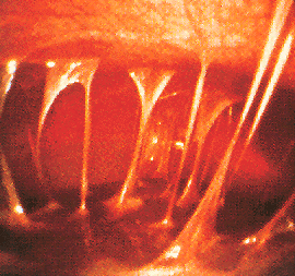 Chamberlain Property Management on Disseminated Gonococcal Infection