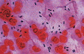 Sputum Test Results For Pneumonia