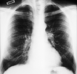 Betty's Chest X-ray; Turn on graphics to view image.