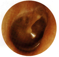 Turn on graphics to view Sally's tympanic membrane