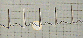 Sally's ECG
