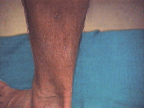 Mr. Potter's Left Calf