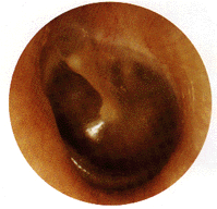 Turn on graphics to view Helen's tympanic membrane