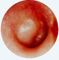 Left tympanic membrane