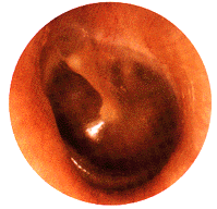 Right tympanic membrane