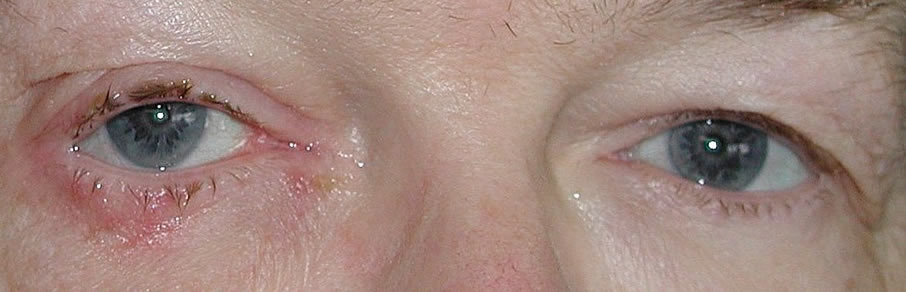Blepharitis (right side)