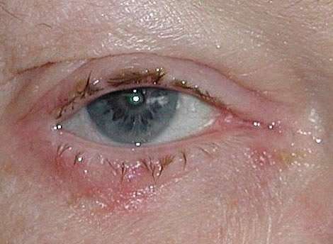 Blepharitis- right eye