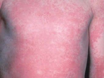 Scarlet Fever Rash  YourCareEverywhere