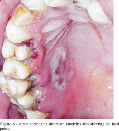 Patient with ANUG with ulceration on hard palate