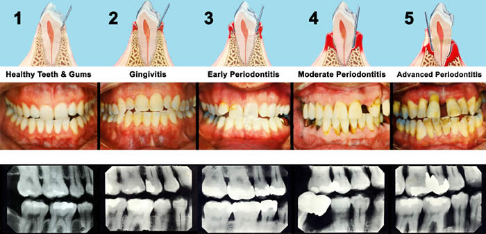 Progression from healthy teeth and gums to advanced periodontitis in five steps