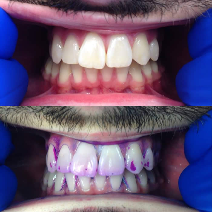Use of plaque revealing gel to demonstrate unseen plaque on teeth