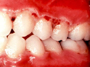 Patient with Acute Necrotizing Ulcerative Gingivitis 1