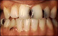 Approximal Surface Caries