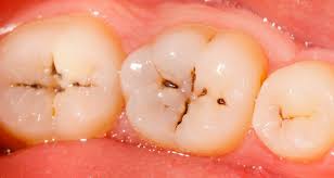 Fissure Caries