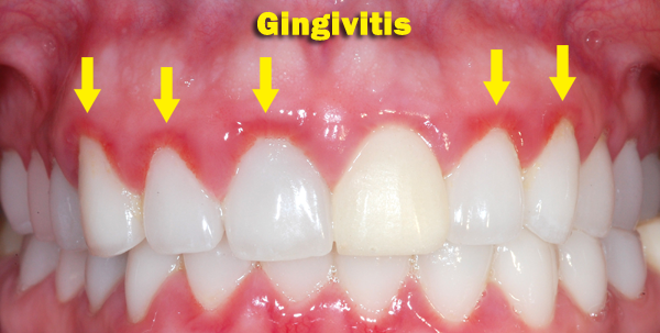 Patient with Gingivitis