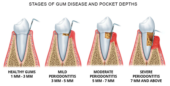 Stages of periodontal disease and periodontal pocket depth