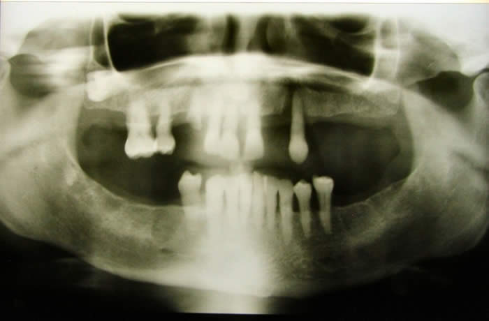 Radiograph of Patient with Severe Periodontitis and Tooth Loss