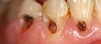 Subgingival Caries