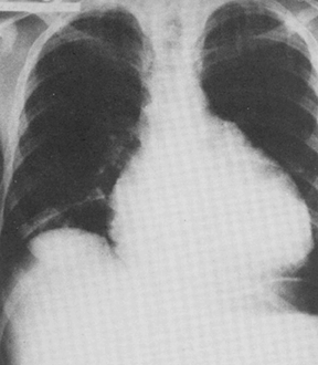 Sally's chest film