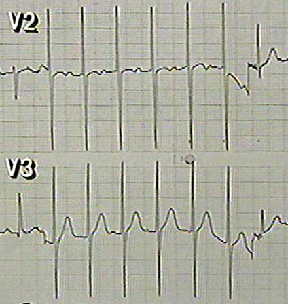 Sally's ECG