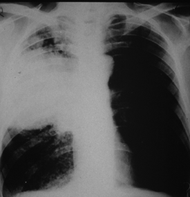 What strain of pneumonia can cause alveolar consolidation?