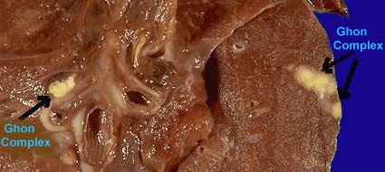 Mycobacterium - Wikipedia