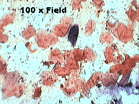 Helen's first sputum sample