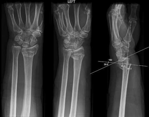 Xray of wrist