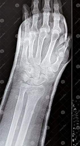Xray of wrist